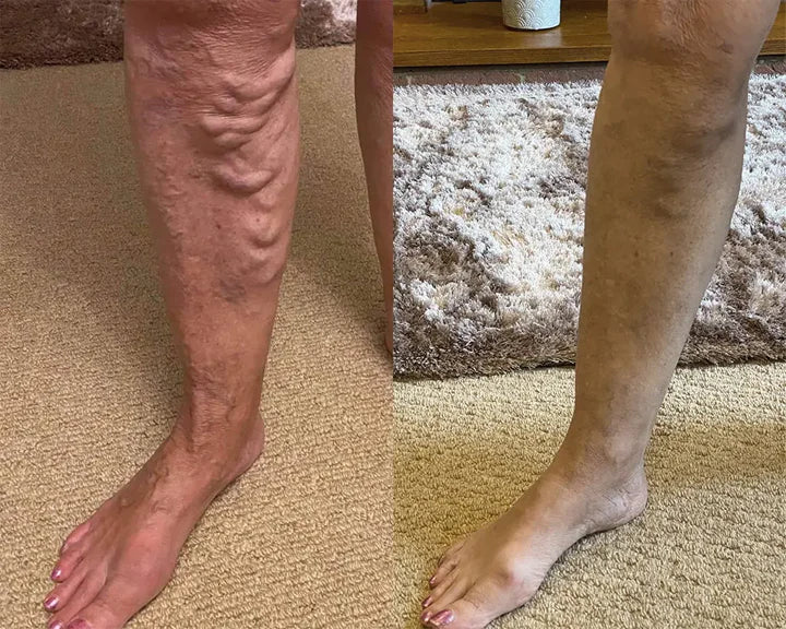 Varicox Vein | Refresca, cuida y mejora la apariencia de tus piernas naturalmente