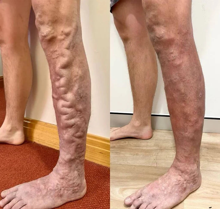 Varicox Vein 50% en la segunda unidad – Refresca, cuida y mejora la apariencia de tus piernas naturalmente