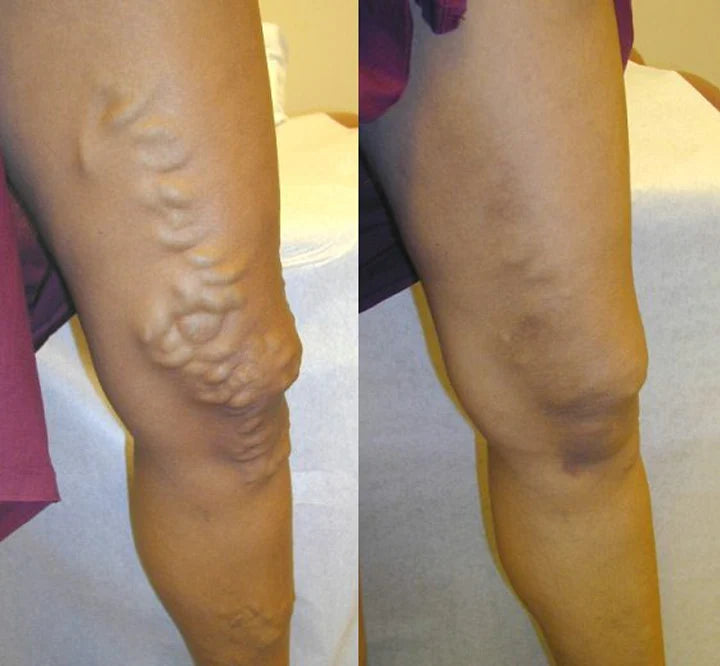 Varicox Vein 50% en la segunda unidad – Refresca, cuida y mejora la apariencia de tus piernas naturalmente