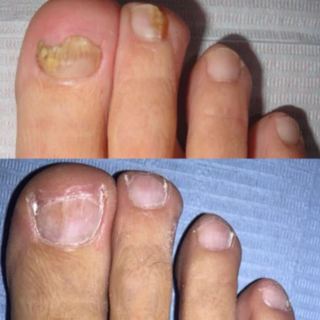 Combo Suero Antihongos X2 — Uñas libres de hongos y listas para crecer