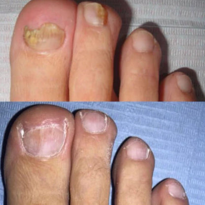 Combo Suero Antihongos X2 — Uñas libres de hongos y listas para crecer