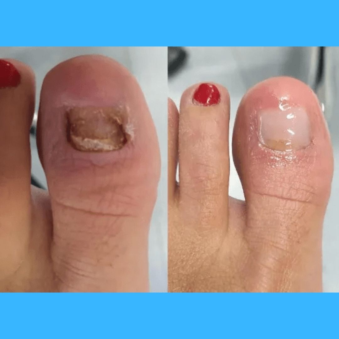Combo Suero Antihongos X2 — Uñas libres de hongos y listas para crecer