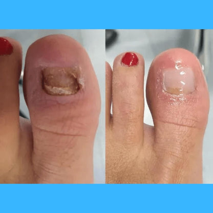 Combo Suero Antihongos X2 — Uñas libres de hongos y listas para crecer