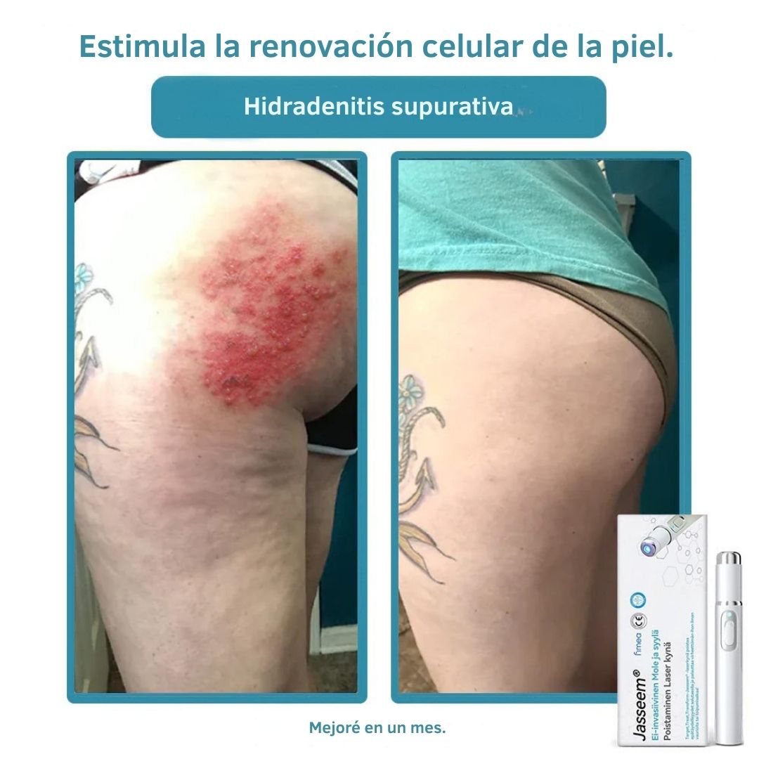 Lápiz láser ProCare: Elimina imperfecciones de la piel desde casa con tecnología profesional