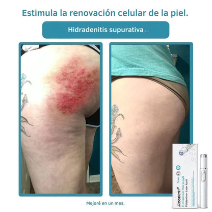 Lápiz láser ProCare: Elimina imperfecciones de la piel desde casa con tecnología profesional