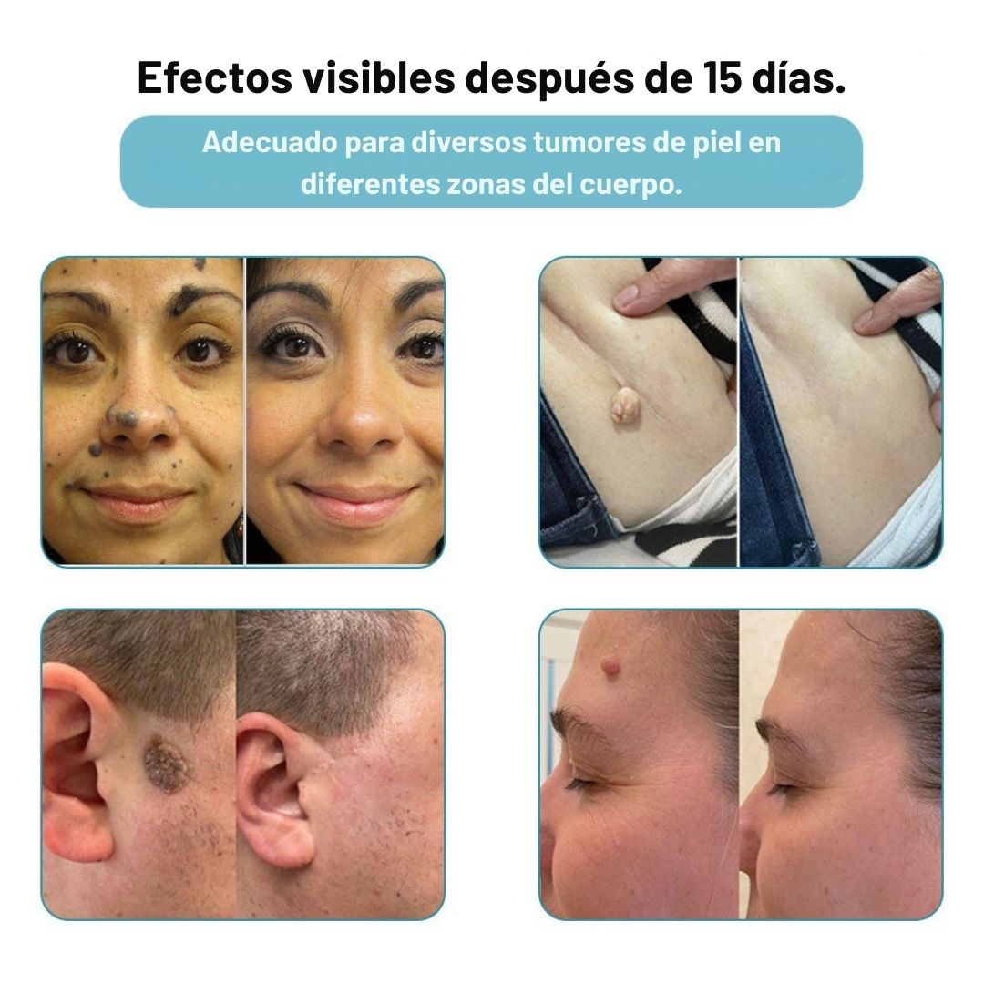 Lápiz láser ProCare: Elimina imperfecciones de la piel desde casa con tecnología profesional