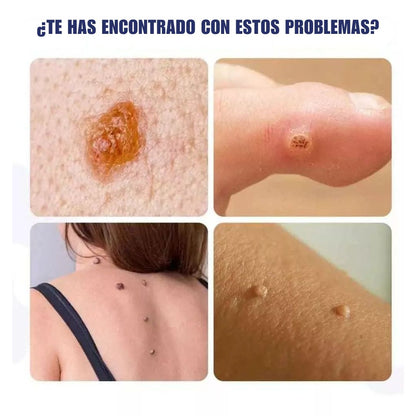 Kit Removedor de Verrugas South Moon –  Líquido Natural + Crema para Eliminar Verrugas + Aplicadores